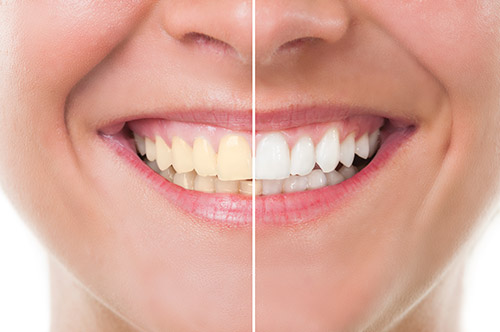 Professional Teeth Whitening New Mexico